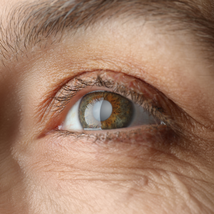 A close up of an eye with cataracts